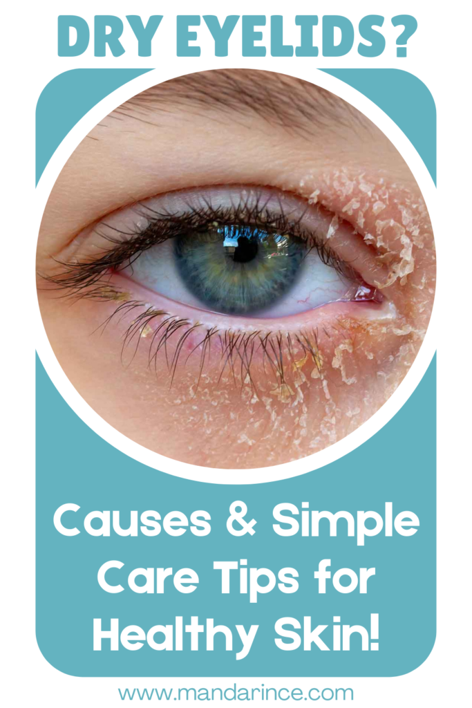 A close-up of a blue eye with dry, flaky skin around the eyelid, highlighting symptoms of dryness and irritation, with a teal background emphasizing skincare and hydration.
